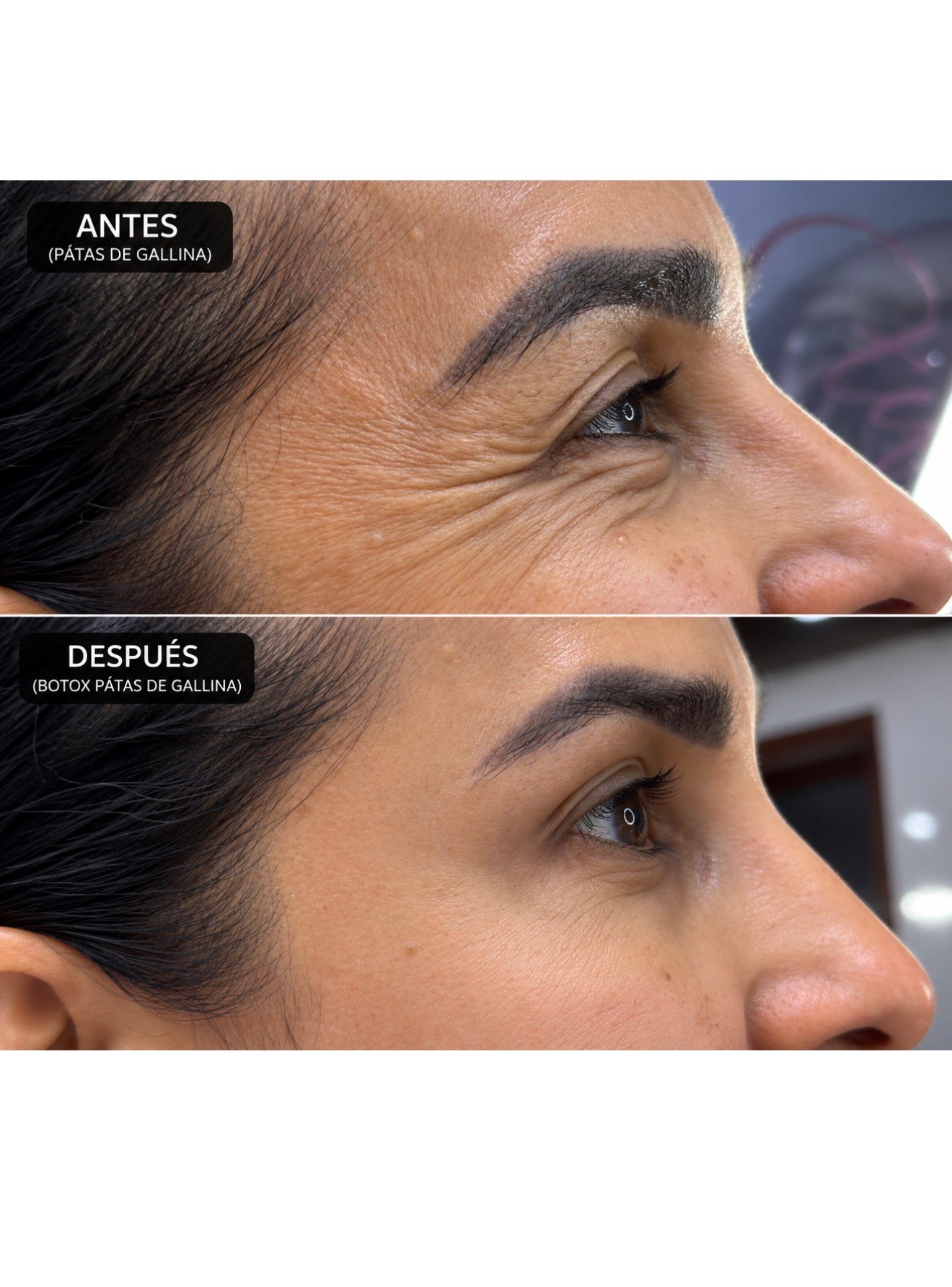 Fotografía original de antes y después de región periocular, sujeta a consentimiento de publicación